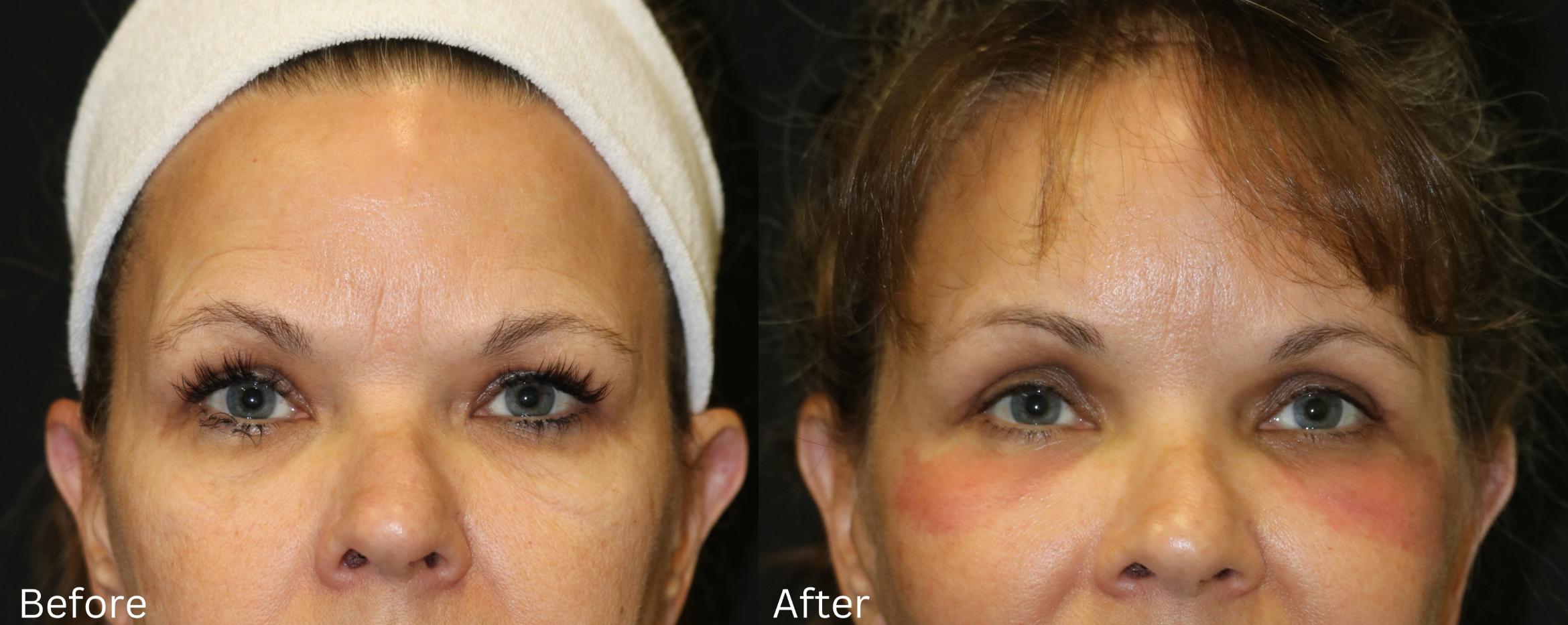Before & After Eyelid Lift Case 241 View 1 View in Santa Rosa, California