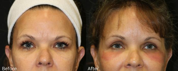Before & After Eyelid Lift Case 241 View 1 View in Santa Rosa, California
