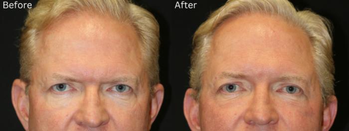 Before & After Eyelid Lift Case 242 View 1 View in Santa Rosa, California