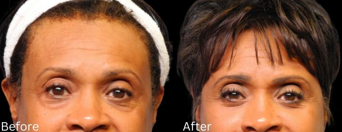 Before & After Eyelid Lift Case 25 View 1 View in Santa Rosa, California