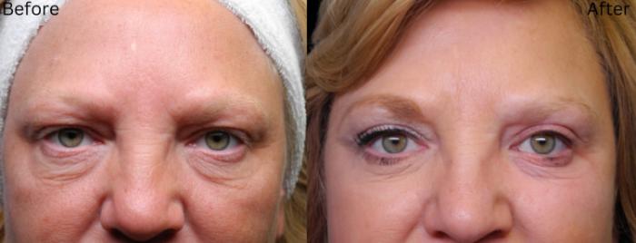 Before & After Eyelid Lift Case 26 View 1 View in Santa Rosa, California