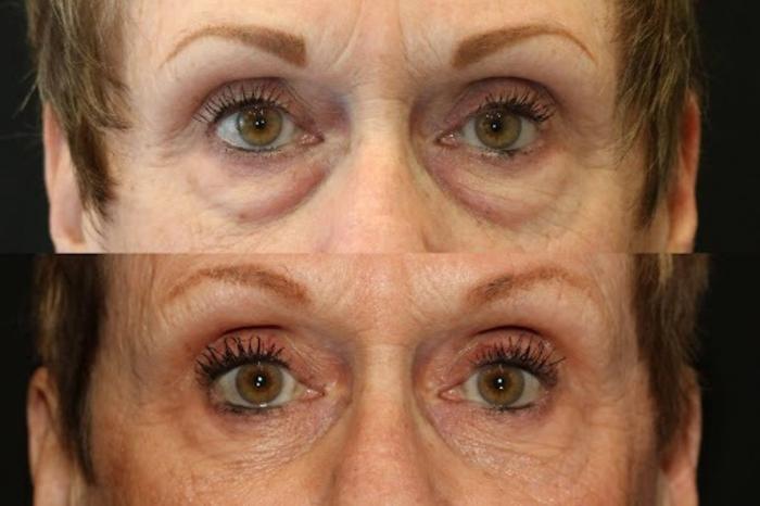 Before & After Eyelid Lift Case 269 View 1 View in Santa Rosa, California