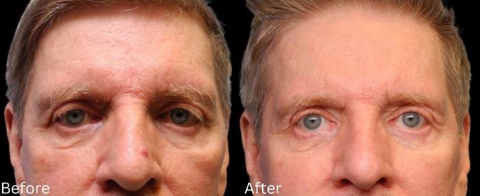 Before & After Eyelid Lift Case 27 View 1 View in Santa Rosa, California