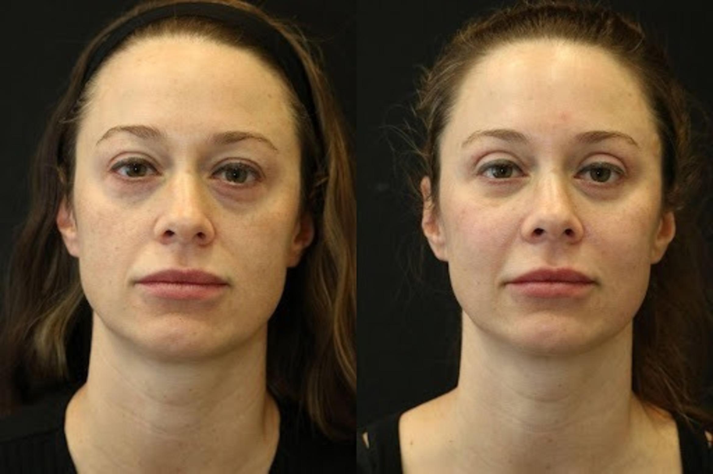 Before & After Eyelid Lift Case 276 View 1 View in Santa Rosa, California