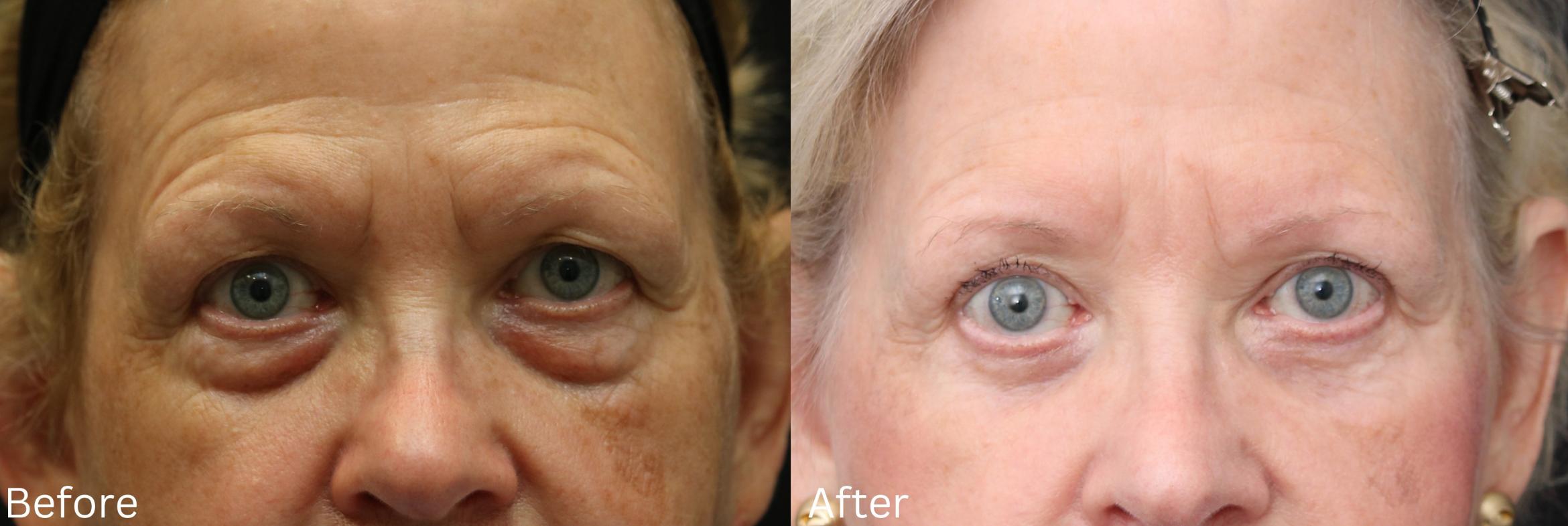 Before & After Eyelid Lift Case 28 View 1 View in Santa Rosa, California