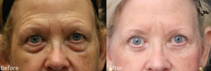 Before & After Eyelid Lift Case 28 View 1 View in Santa Rosa, California
