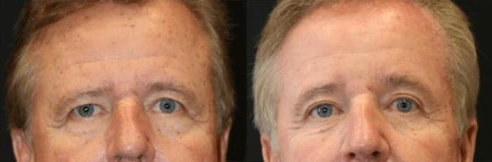 Before & After Eyelid Lift Case 281 View 1 View in Santa Rosa, California