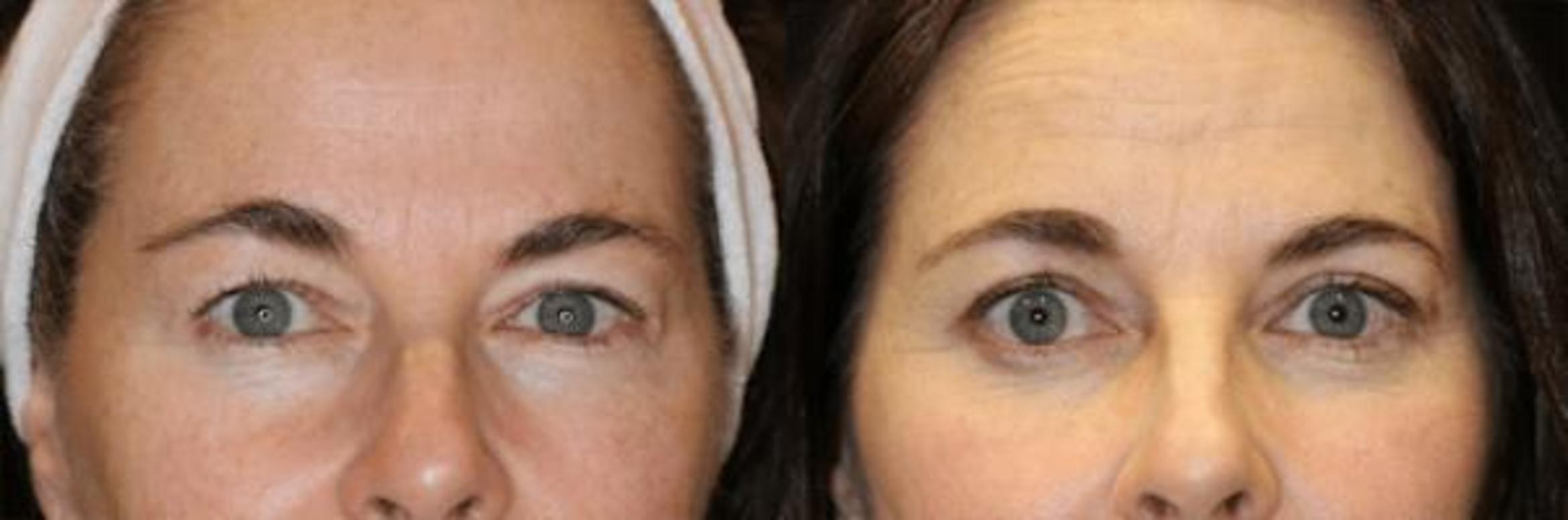 Before & After Eyelid Lift Case 282 View 1 View in Santa Rosa, California