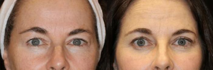 Before & After Eyelid Lift Case 282 View 1 View in Santa Rosa, California
