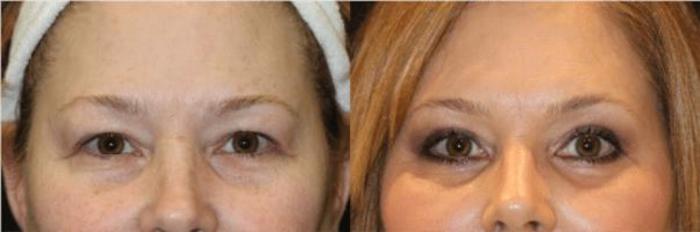 Before & After Eyelid Lift Case 283 View 1 View in Santa Rosa, California