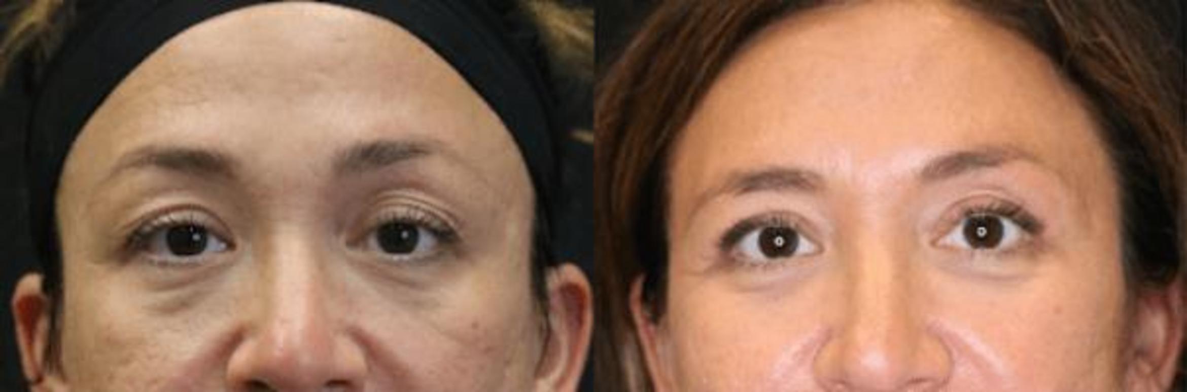 Before & After Eyelid Lift Case 285 View 1 View in Santa Rosa, California