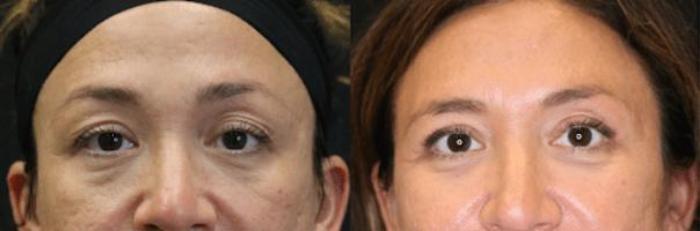 Before & After Eyelid Lift Case 285 View 1 View in Santa Rosa, California