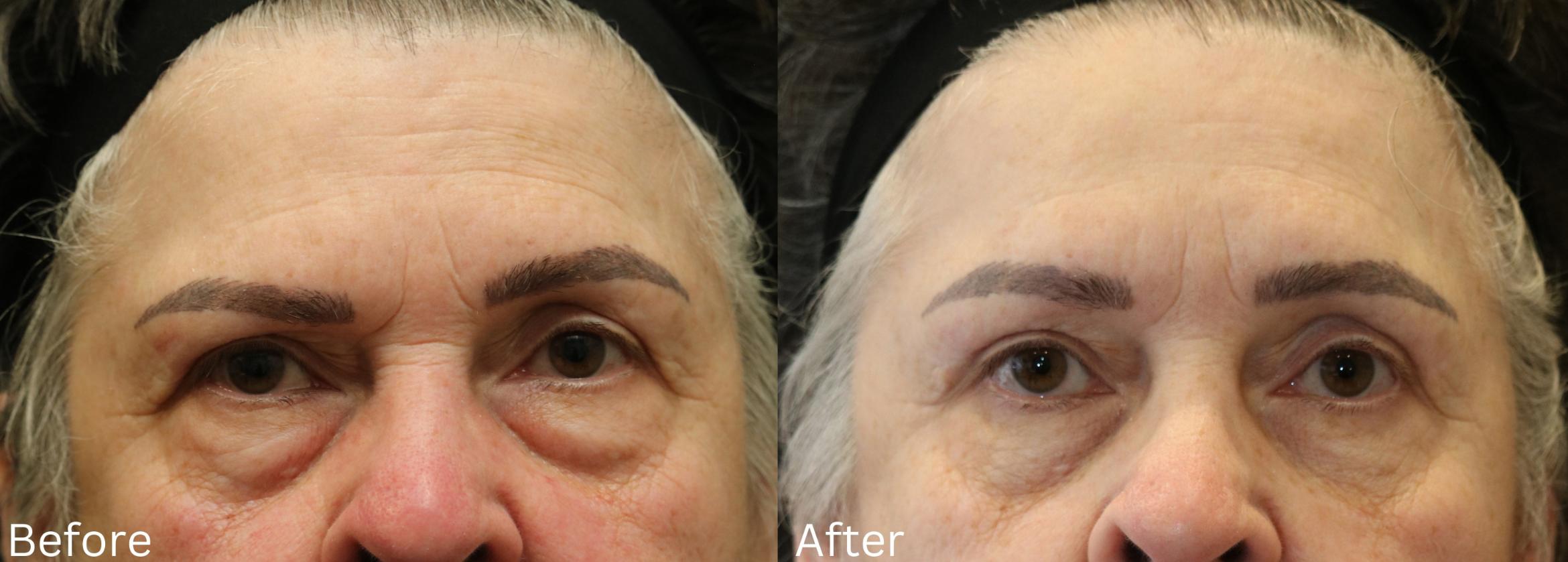 Before & After Eyelid Lift Case 29 View 1 View in Santa Rosa, California
