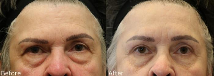 Before & After Eyelid Lift Case 29 View 1 View in Santa Rosa, California