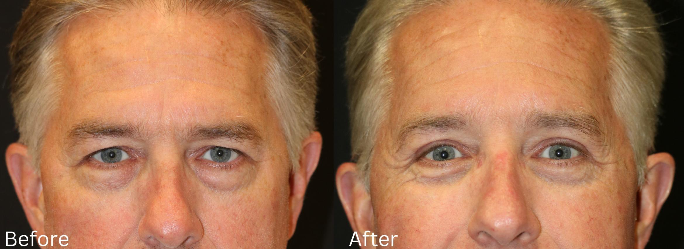 Before & After Eyelid Lift Case 30 View 1 View in Santa Rosa, California
