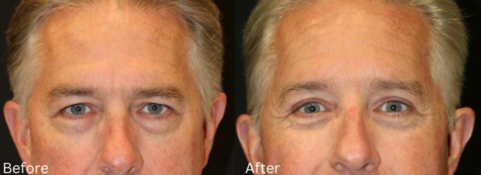 Before & After Eyelid Lift Case 30 View 1 View in Santa Rosa, California