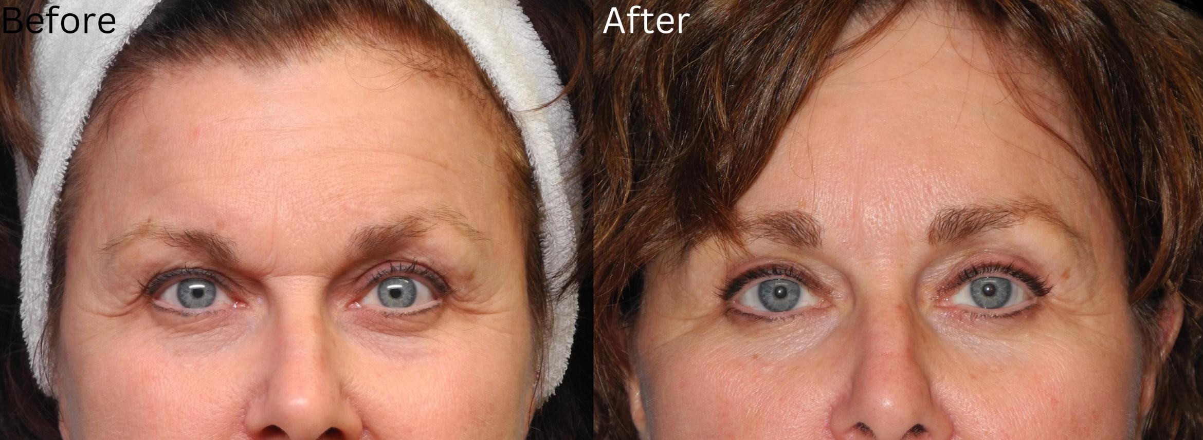Before & After Eyelid Lift Case 31 View 1 View in Santa Rosa, California