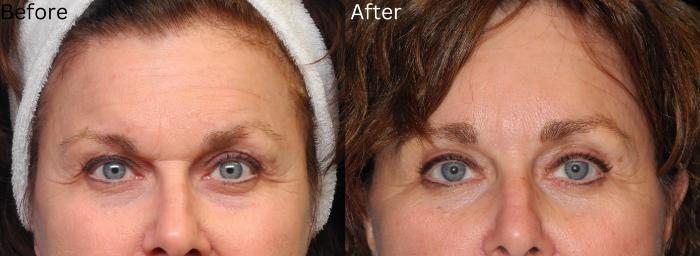 Before & After Eyelid Lift Case 31 View 1 View in Santa Rosa, California