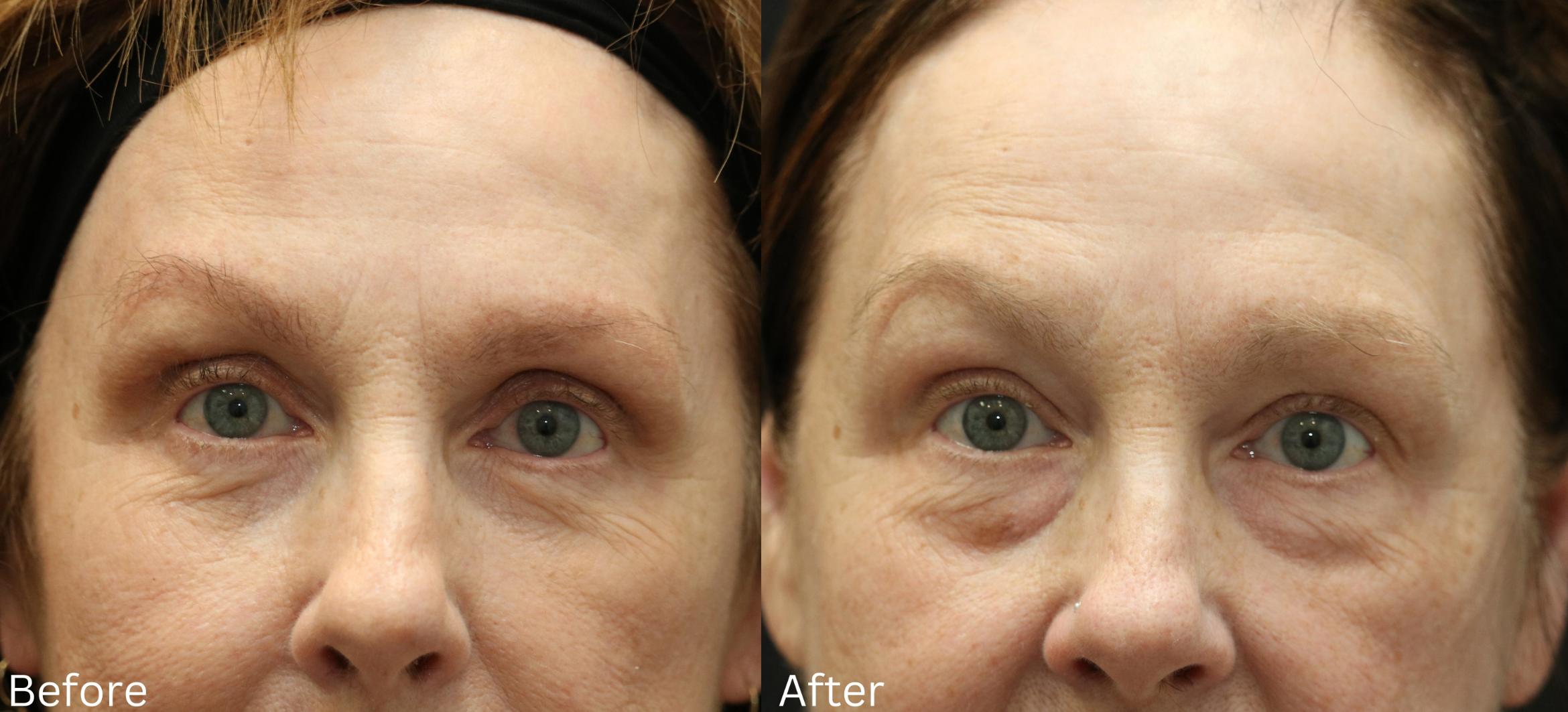 Before & After Eyelid Lift Case 32 View 1 View in Santa Rosa, California