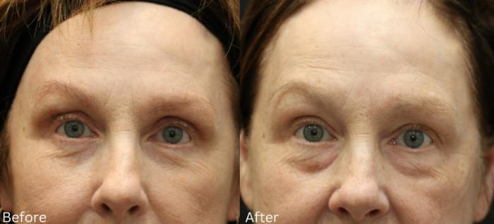 Before & After Eyelid Lift Case 32 View 1 View in Santa Rosa, California