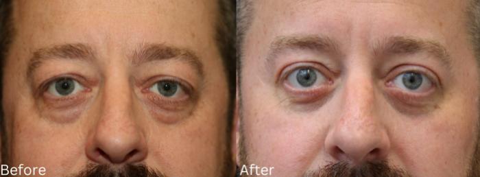 Before & After Eyelid Lift Case 33 View 1 View in Santa Rosa, California