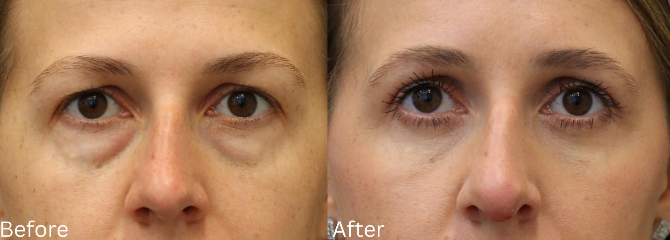 Before & After Eyelid Lift Case 34 View 1 View in Santa Rosa, California
