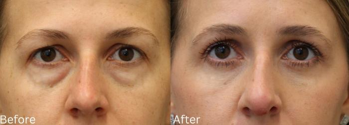 Before & After Eyelid Lift Case 34 View 1 View in Santa Rosa, California