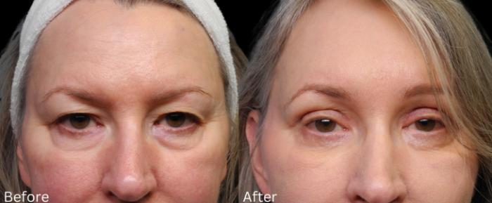 Before & After Eyelid Lift Case 35 View 1 View in Santa Rosa, California