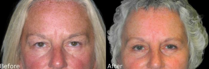 Before & After Eyelid Lift Case 36 View 1 View in Santa Rosa, California