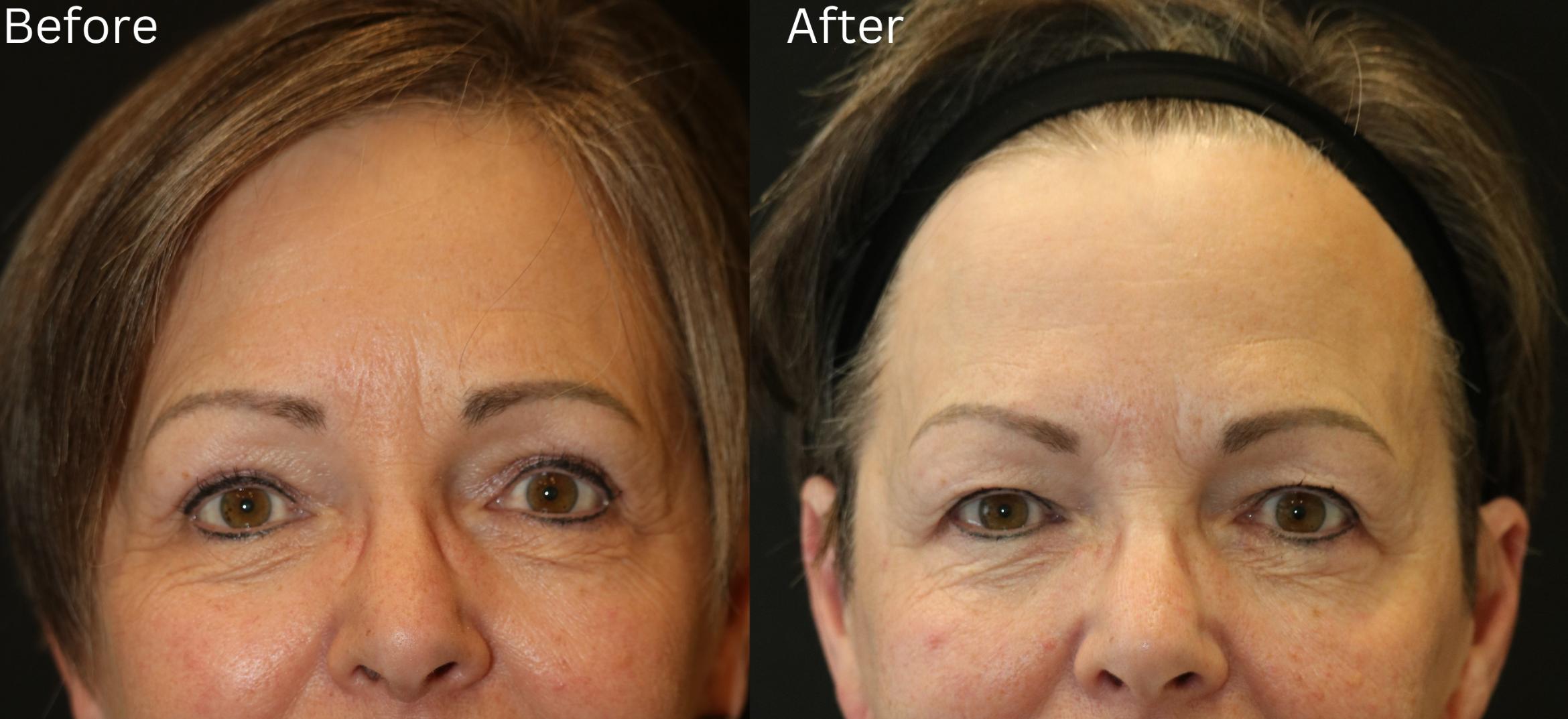 Before & After Eyelid Lift Case 37 View 1 View in Santa Rosa, California