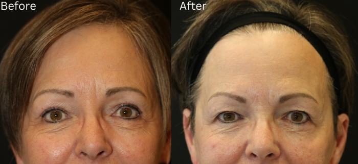 Before & After Eyelid Lift Case 37 View 1 View in Santa Rosa, California