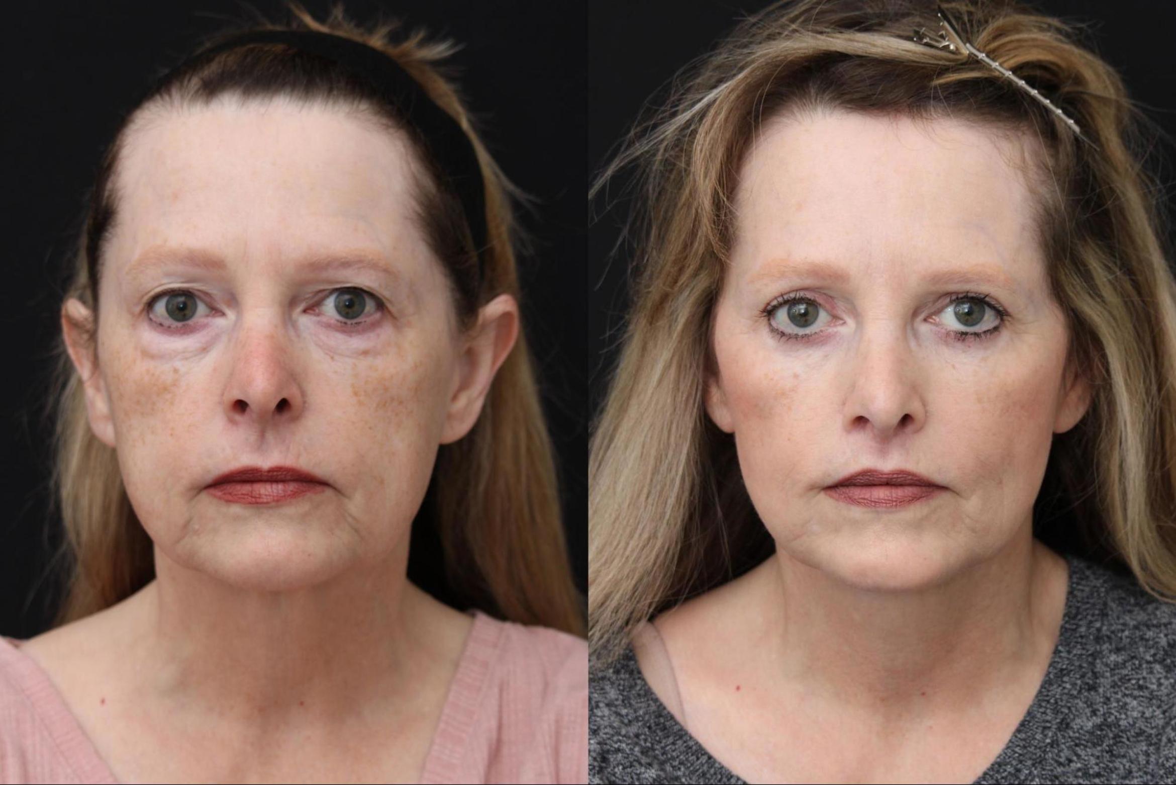 Before & After Eyelid Lift Case 370 View 1 View in Santa Rosa, California