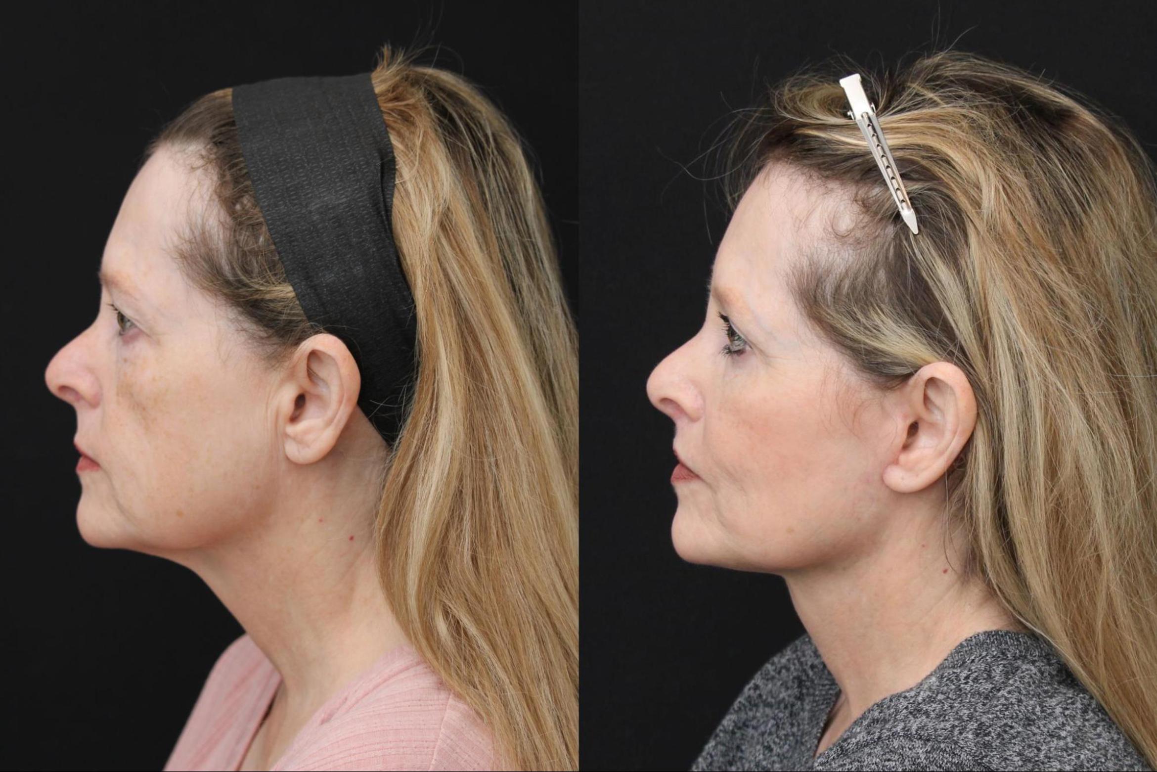 Before & After Eyelid Lift Case 370 View 2 View in Santa Rosa, California