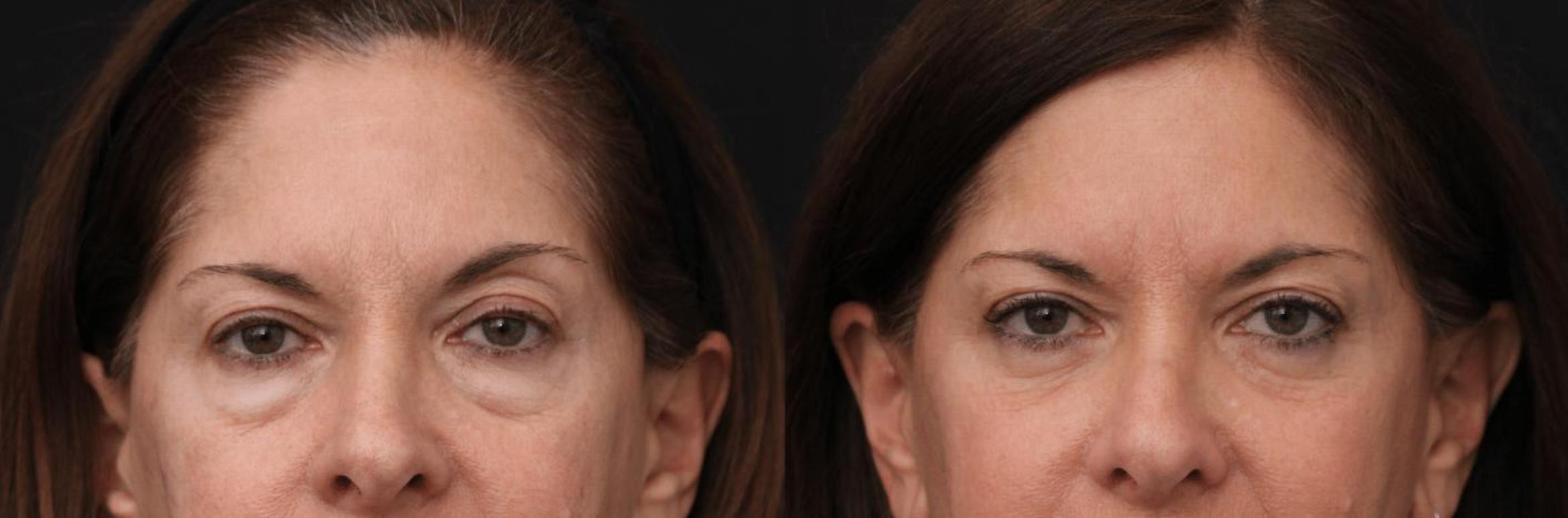 Before & After Eyelid Lift Case 374 View 1 View in Santa Rosa, California
