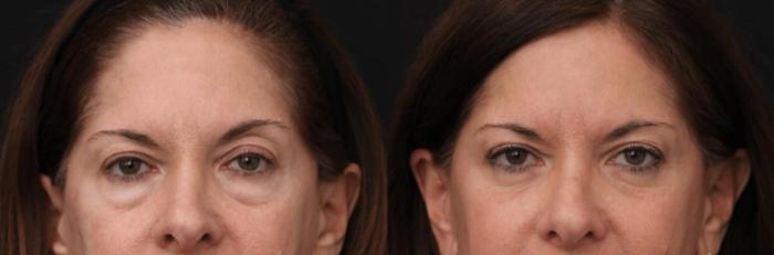 Before & After Eyelid Lift Case 374 View 1 View in Santa Rosa, California