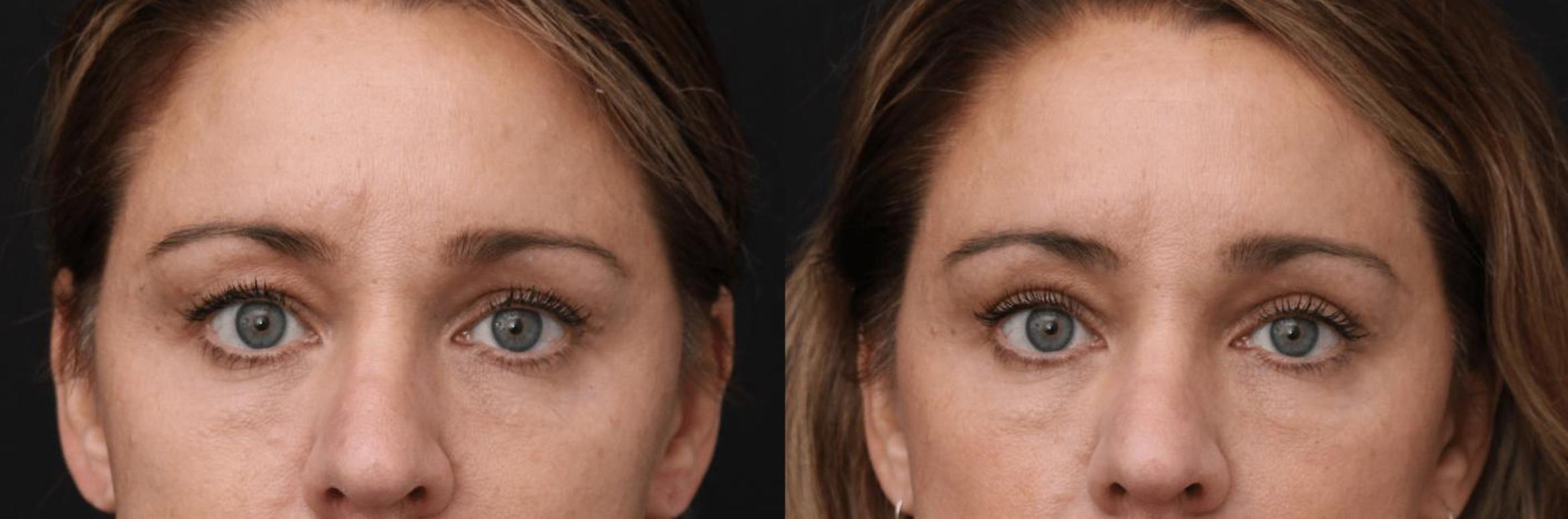 Before & After Eyelid Lift Case 375 View 1 View in Santa Rosa, California