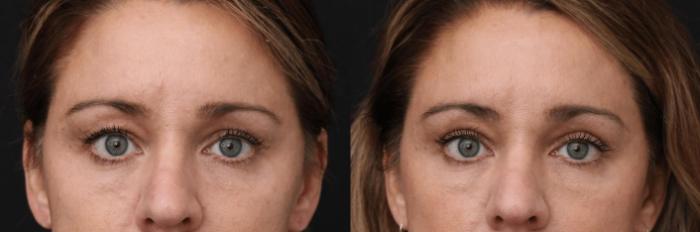 Before & After Eyelid Lift Case 375 View 1 View in Santa Rosa, California