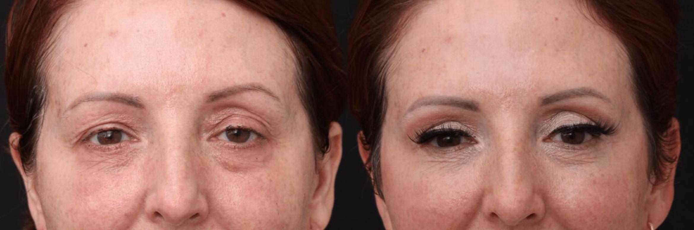 Before & After Eyelid Lift Case 390 View 1 View in Santa Rosa, California