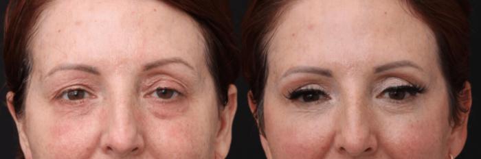 Before & After Eyelid Lift Case 390 View 1 View in Santa Rosa, California