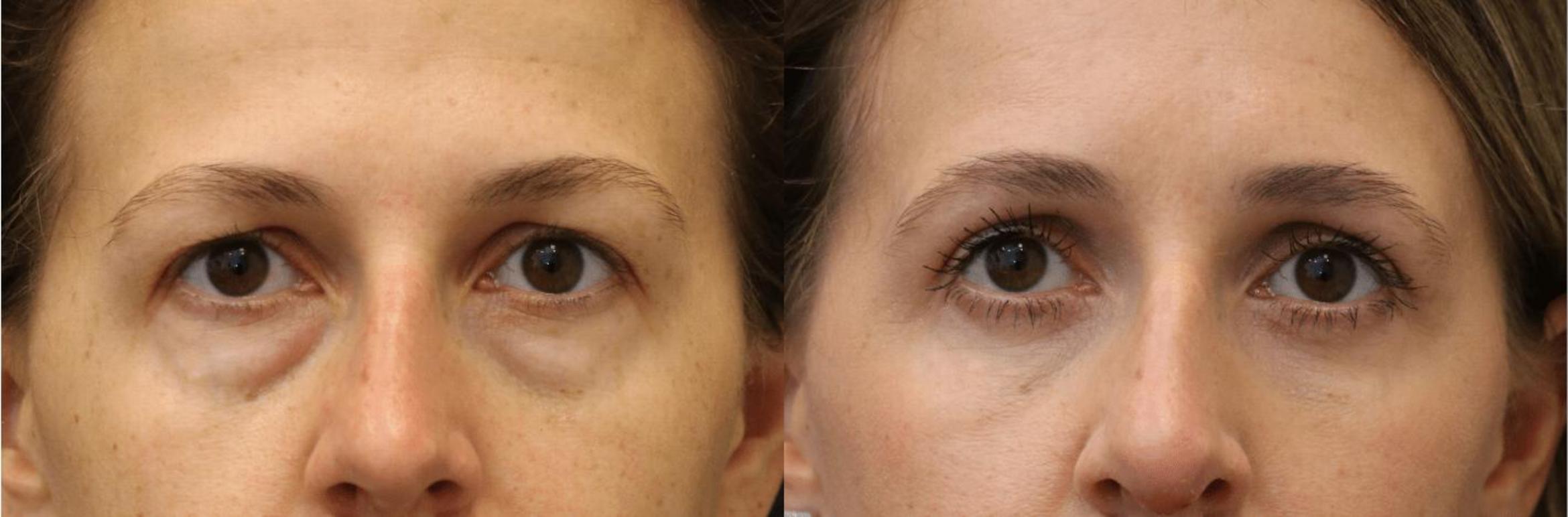 Before & After Eyelid Lift Case 393 View 1 View in Santa Rosa, California