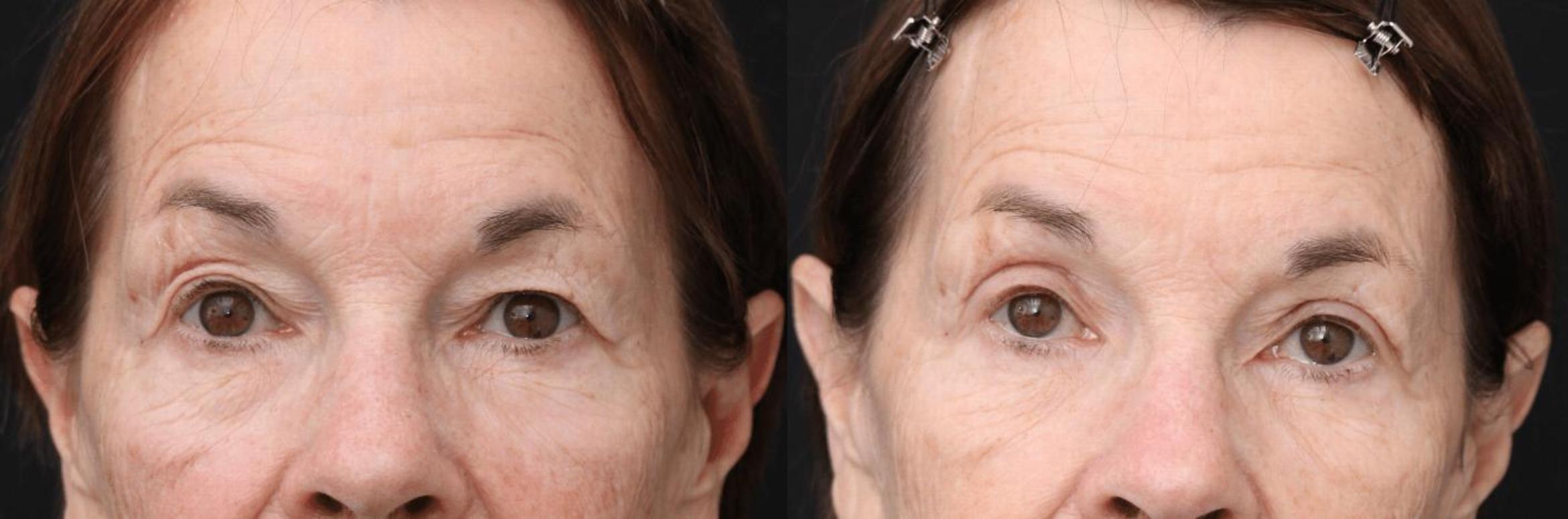 Before & After Eyelid Lift Case 394 View 1 View in Santa Rosa, California