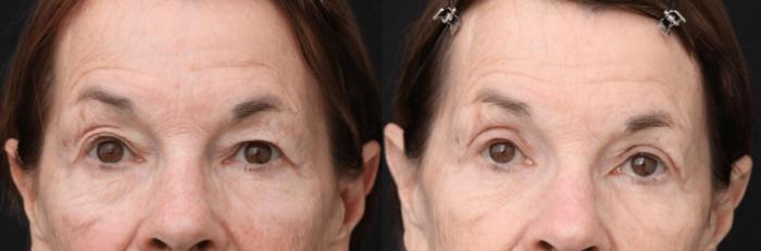 Before & After Eyelid Lift Case 394 View 1 View in Santa Rosa, California