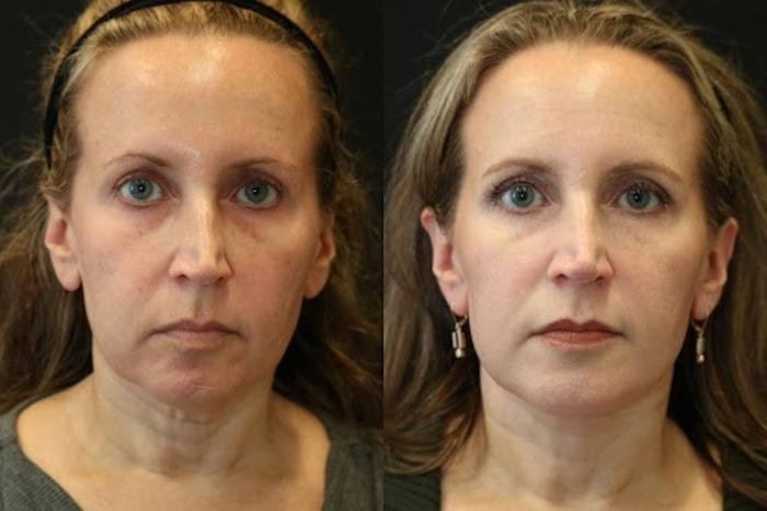 Before & After Facelift & Neck Lift Case 271 View 1 View in Santa Rosa, California