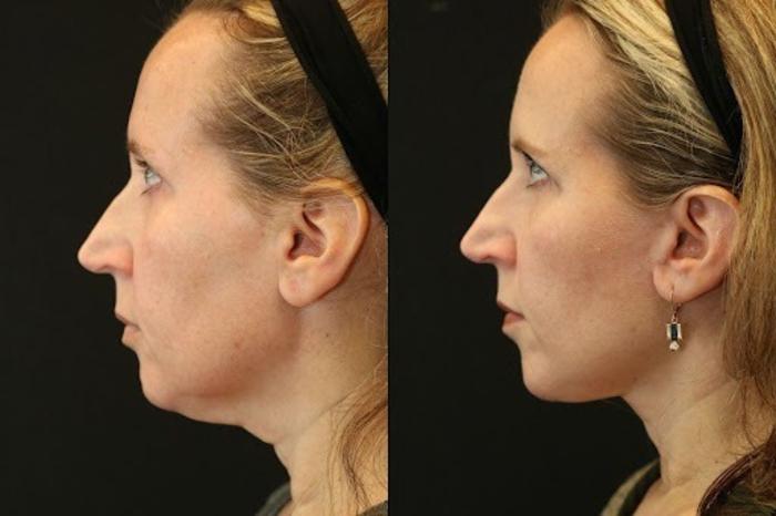Before & After Facelift & Neck Lift Case 271 View 2 View in Santa Rosa, California