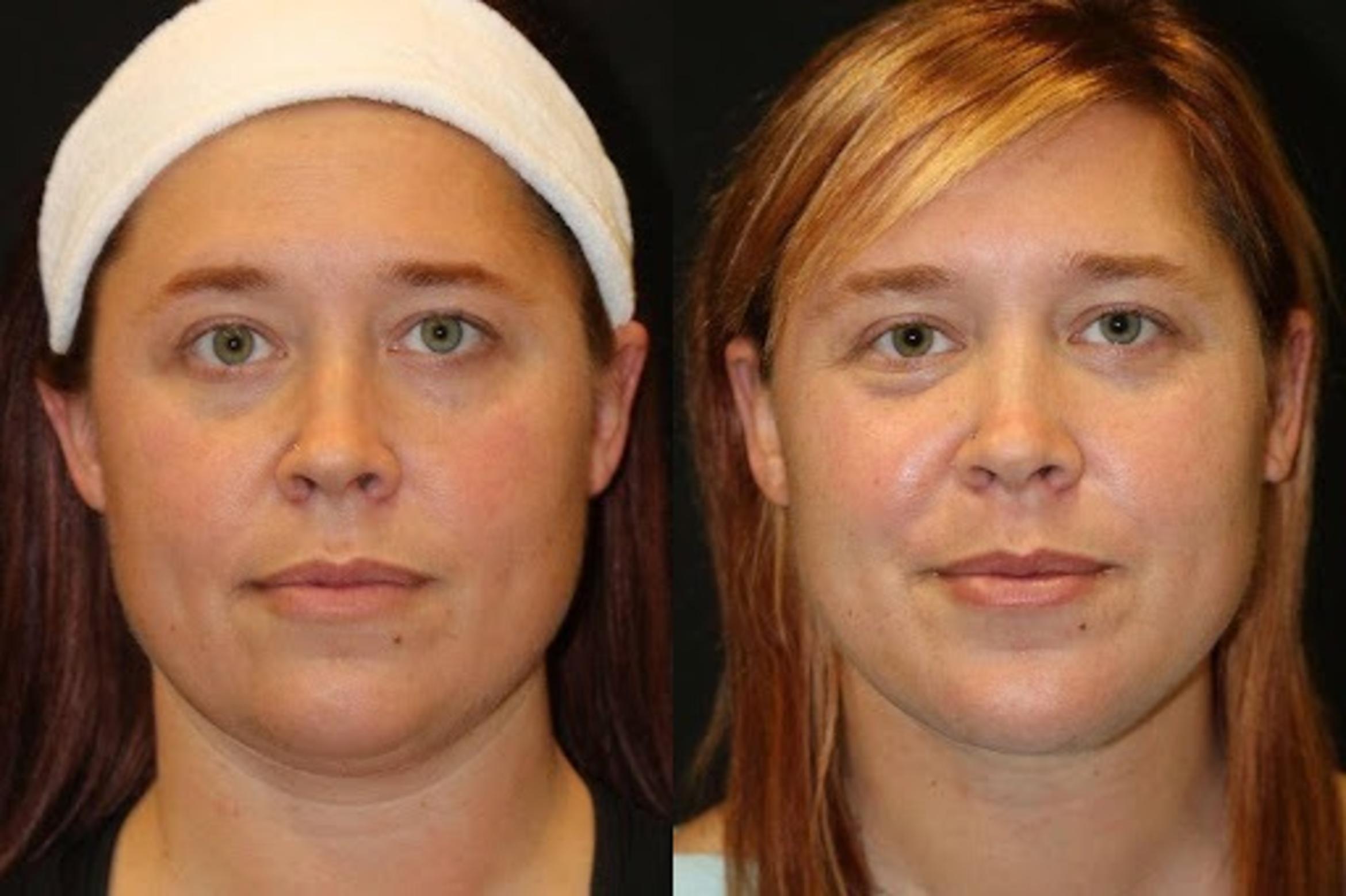 Before & After Facelift & Neck Lift Case 274 View 1 View in Santa Rosa, California