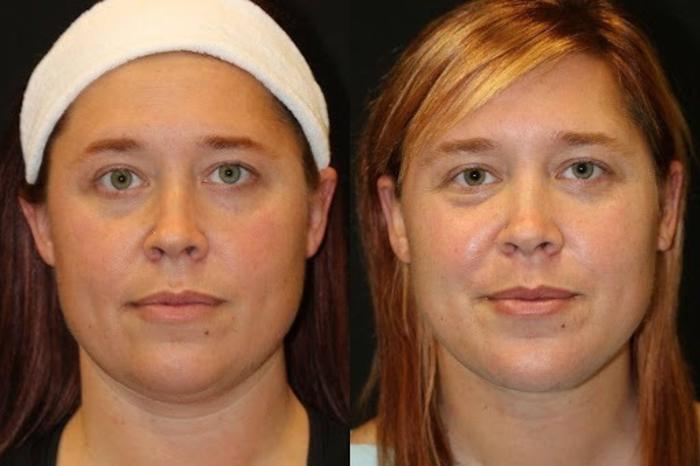 Before & After Facelift & Neck Lift Case 274 View 1 View in Santa Rosa, California