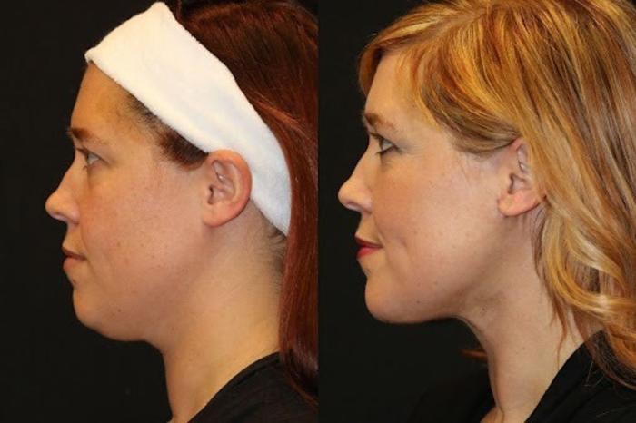 Before & After Facelift & Neck Lift Case 274 View 2 View in Santa Rosa, California