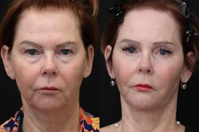 Before & After Facelift & Neck Lift Case 275 View 1 View in Santa Rosa, California