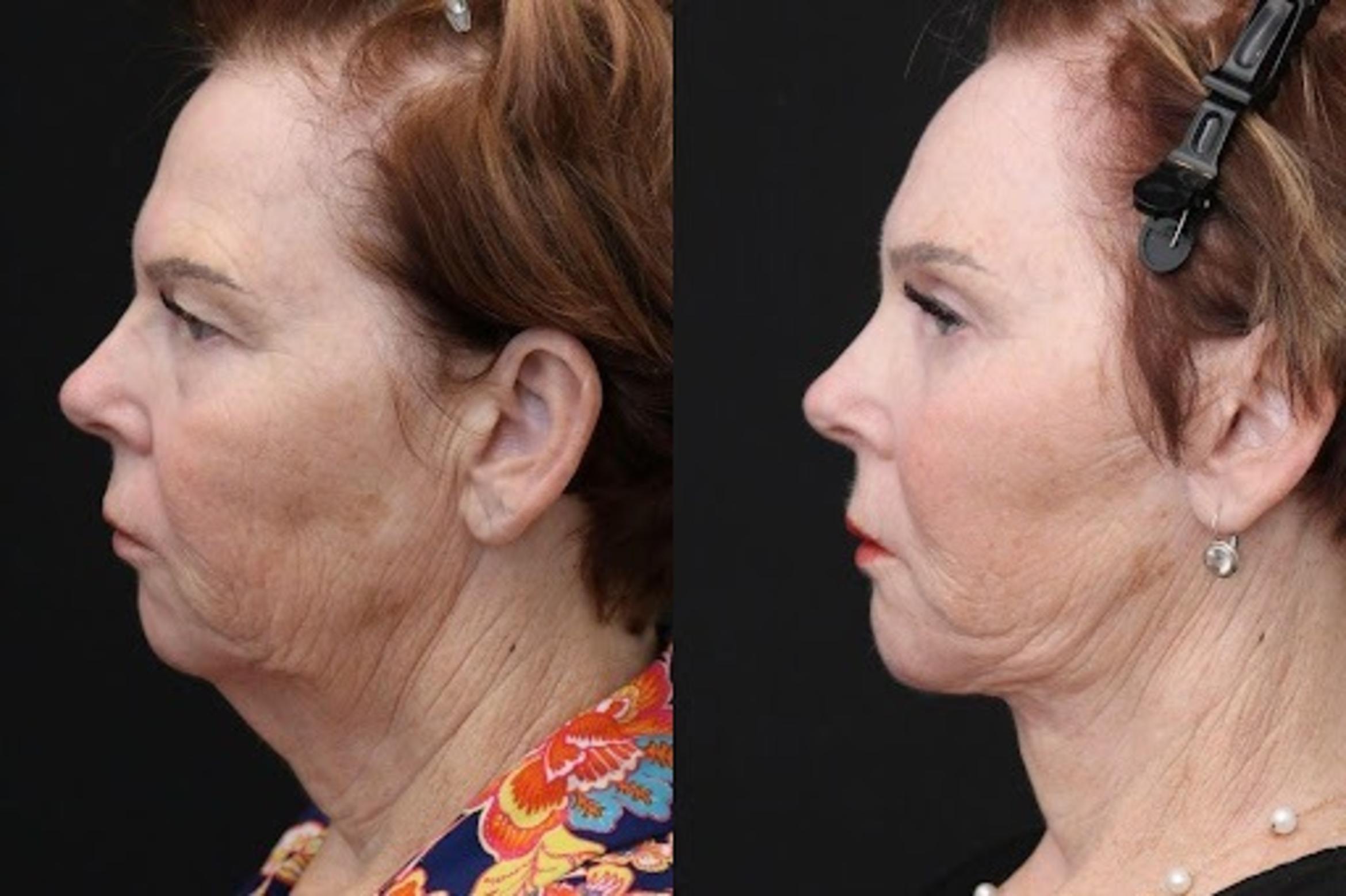 Before & After Facelift & Neck Lift Case 275 View 2 View in Santa Rosa, California