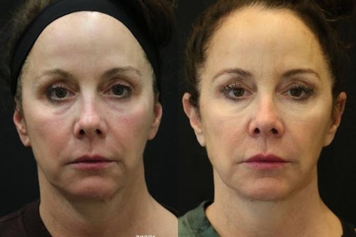 Before & After Facelift & Neck Lift Case 277 View 1 View in Santa Rosa, California